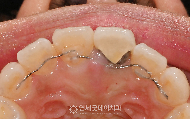 30대 앞니 임플란트 전 치아 부위가 검게 변한 모습
