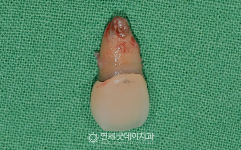 30대 앞니 임플란트를 위해 기존 치아 발치