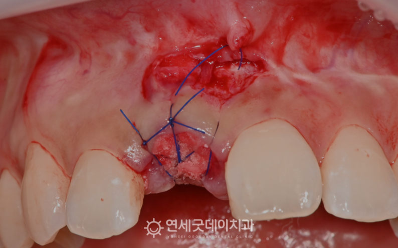 30대 앞니임플란트 과정 - 뼈이식 진행