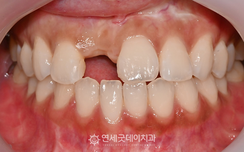 30대 앞니 임플란트 과정 - 뺘이식 후 모습
