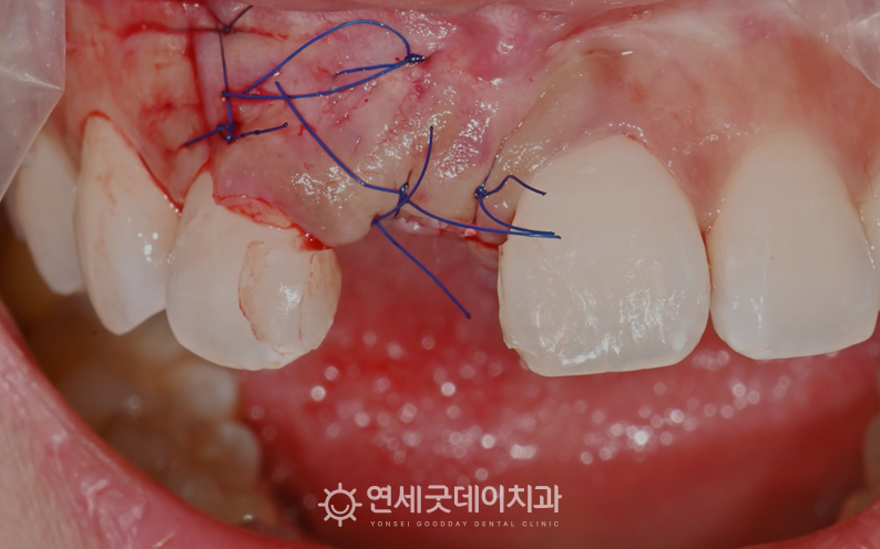30대 앞니 임플란트 과정 - 추가적인 뼈이식 진행