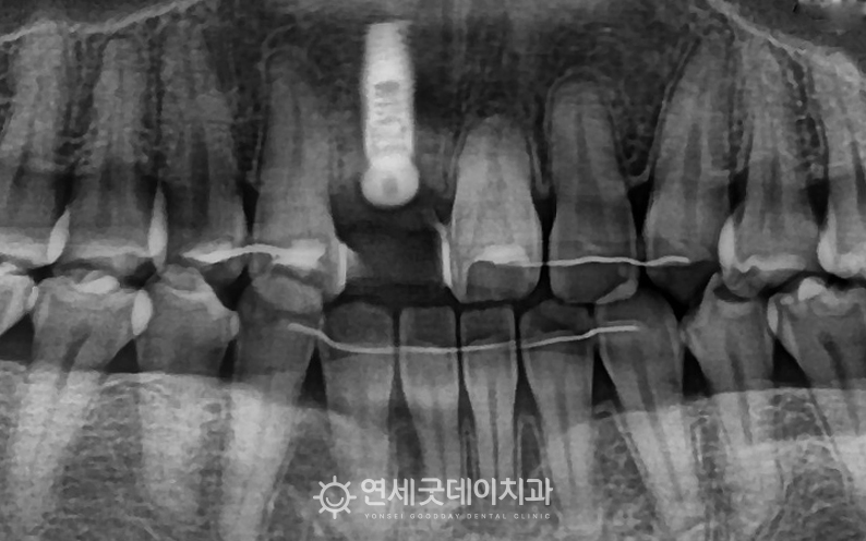 30대 앞니 임플란트 식립 후 엑스레이 모습