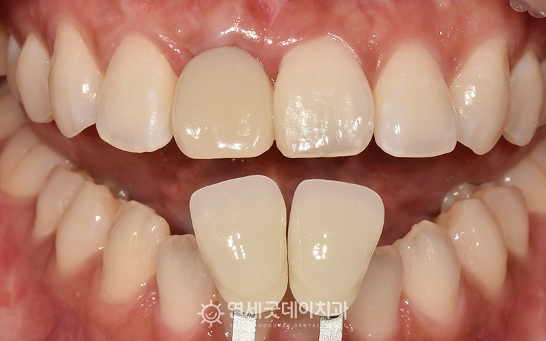 30대 앞니 임플란트 쉐이드대조