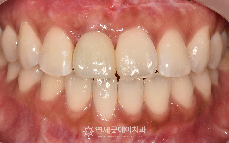 30대 앞니 임플란트 종결