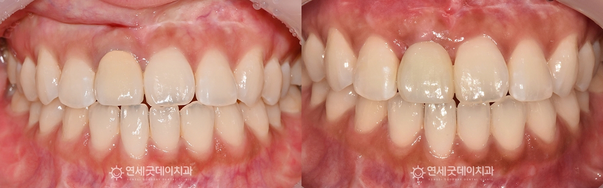 30대 앞니 임플란트 치료 전후 비교