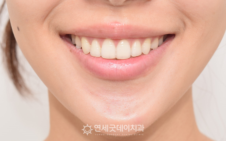 잇몸뼈 튀어나옴으로 인해 치조골성형술 희망하심