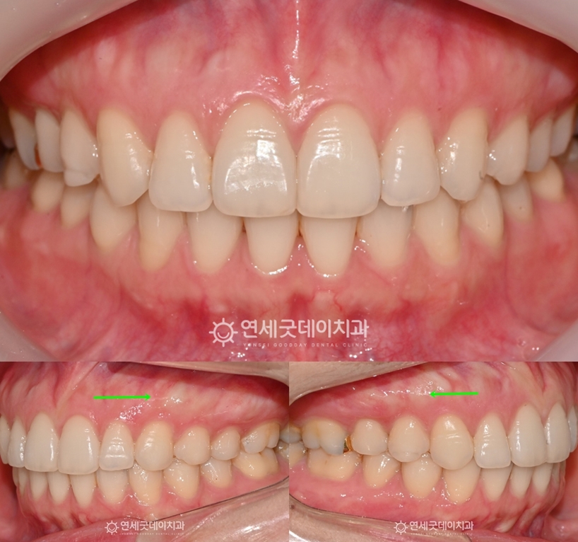 치조골성형전 상악 좌우로 잇몸뼈 튀어나옴 관찰됨