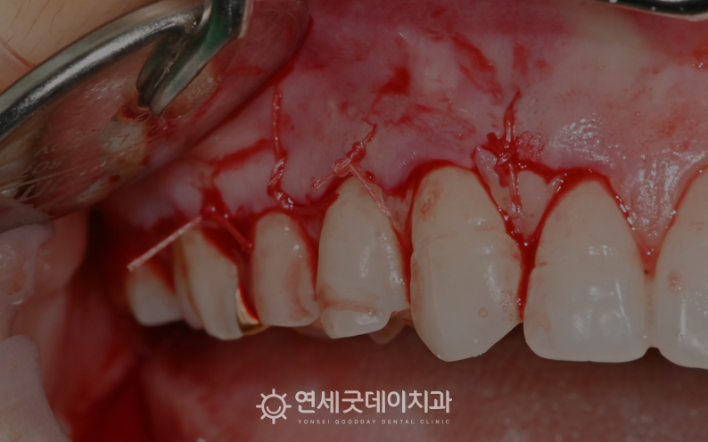 치조골성형술 과정 1