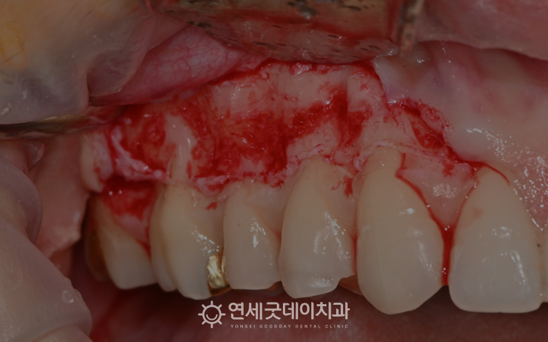 치조골성형술 과정2