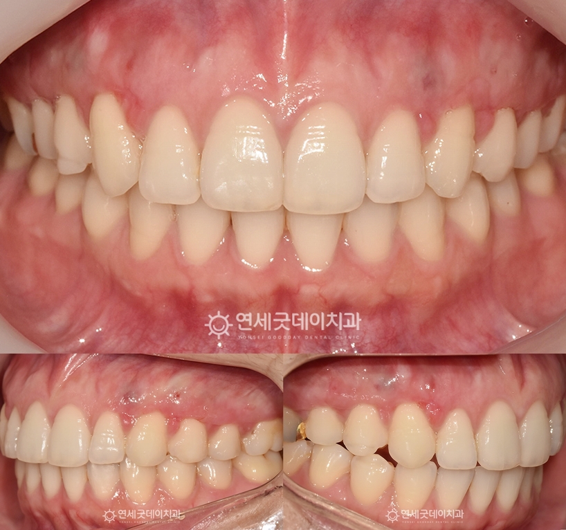 치조골성형술을 통해 잇몸뼈 튀어나옴이 해소된 모습