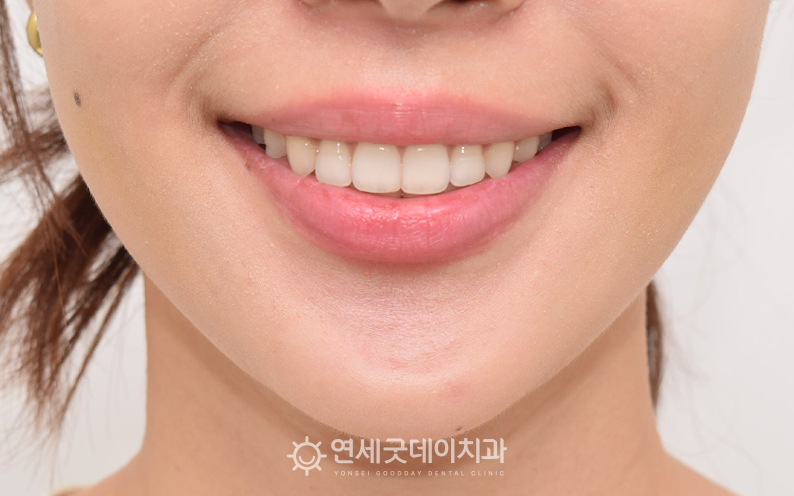 치조골성형술 후 안모