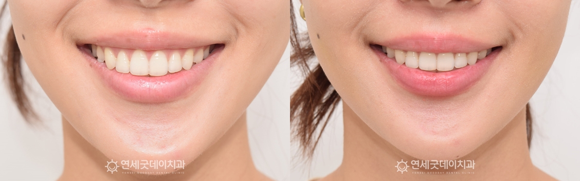치조골성형술 안모 정면 전후비교
