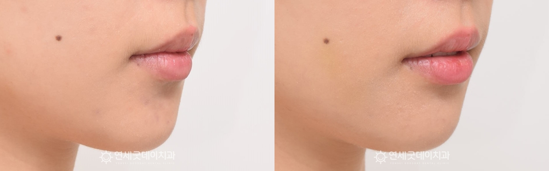 치조골성형술 안모 측면 전후비교