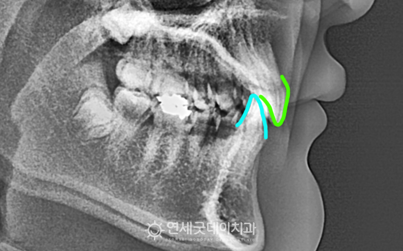 과개교합 교정 전 엑스레이