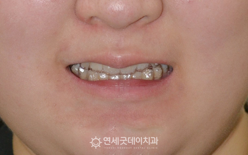 인비절라인을 통한 과개교합 교정 진행 - 착용 모습