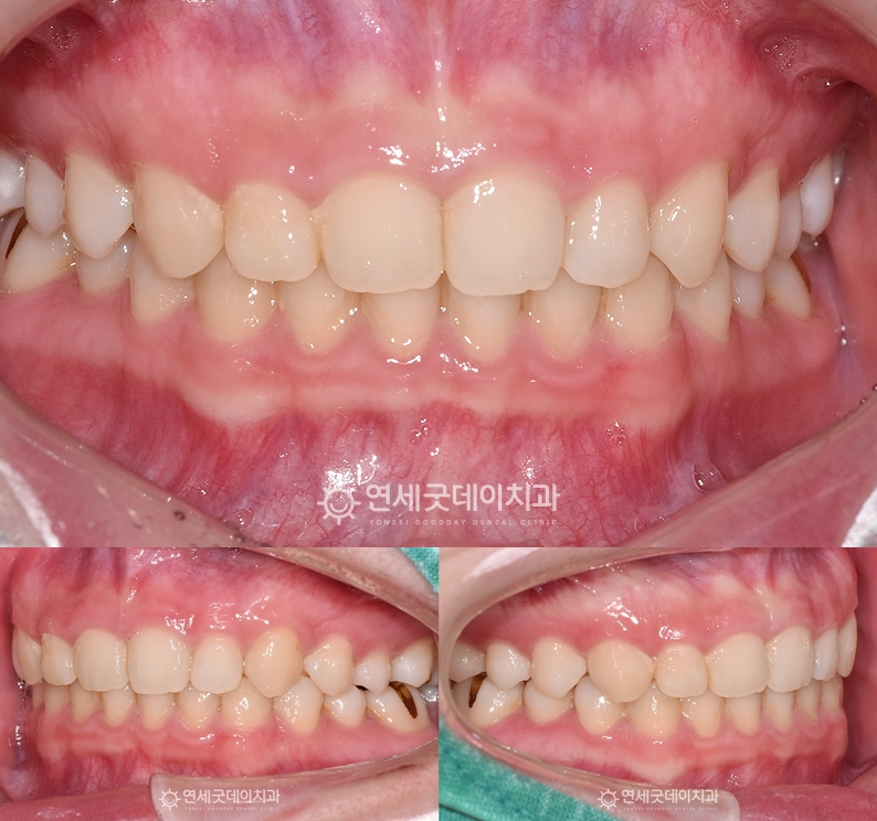 인비절라인을 통한 과개교합 교정 종결