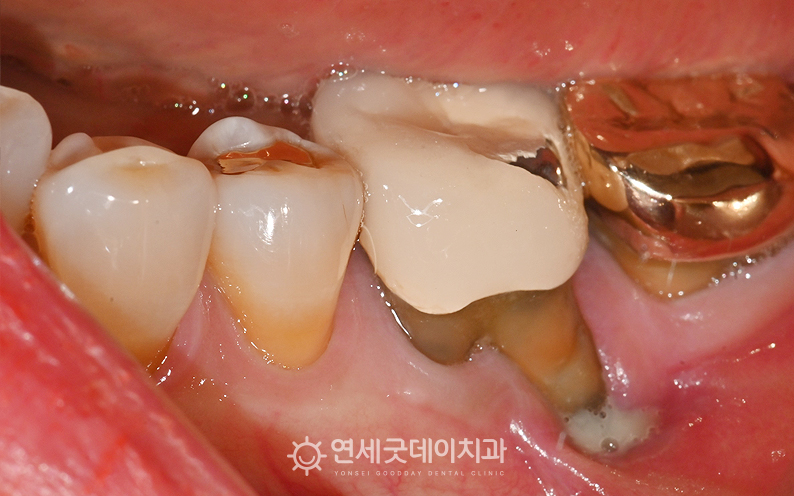 잇몸내려앉음으로 인해 엠도게인과 핀홀 치료 희망하심
