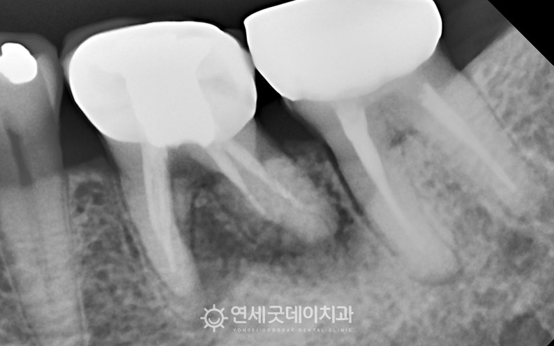 치료전 잇몸 부위의 염증