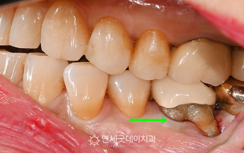 잇몸내려앉음 치료전 모습 (염증 완화된 모습)