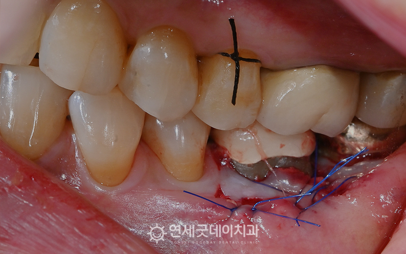 잇몸 내려앉음을 개선하기 위해 엠도게인과 핀홀 치료 시행