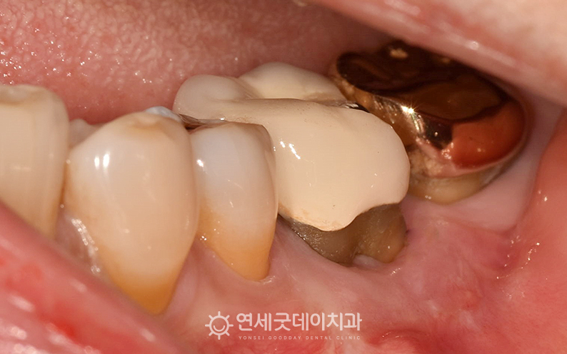 엠도게인 및 핀홀 치료 후 잇몸 내려앉음이 개선된 모습