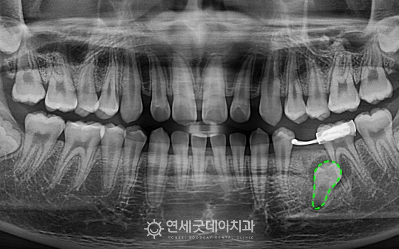 청소년 매복치 견인교정 전 하악에 매복된 치아