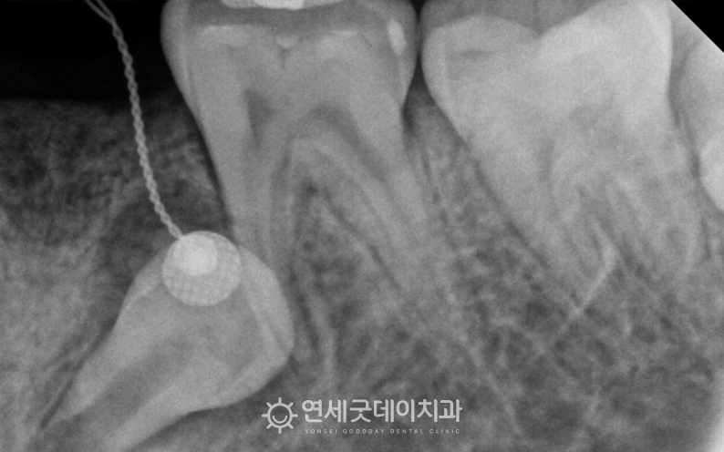 매복치 견인교정을 위해 잇몸 절개 후 치아에 장치를 부착함