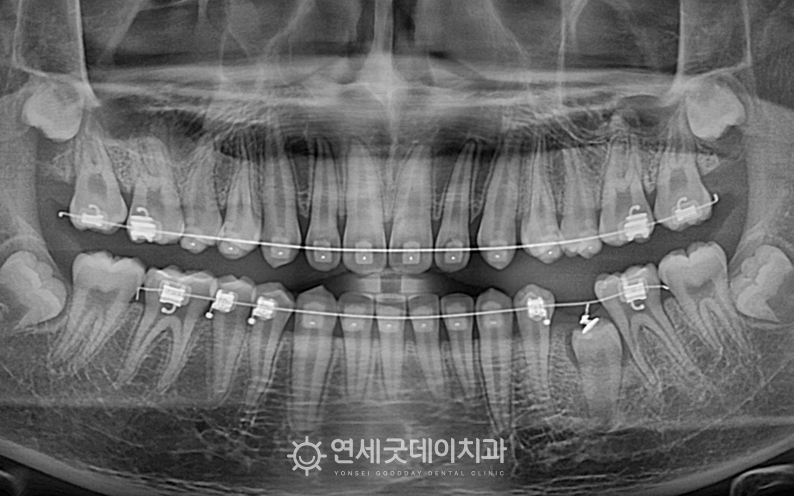 청소년 매복치 견인교정 진행중