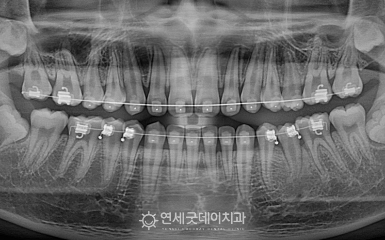 청소년 매복치 견인교정 진행중