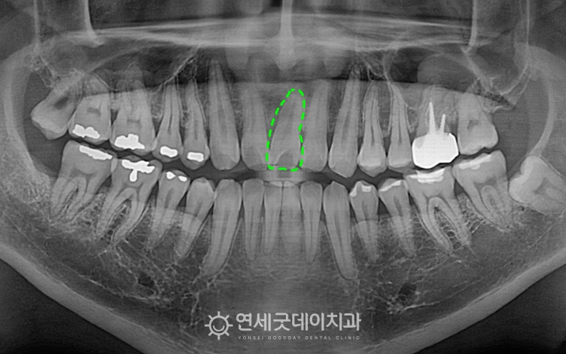 인비절라인 및 앞니 임플란트 치료 전 결손치가 있는 모습
