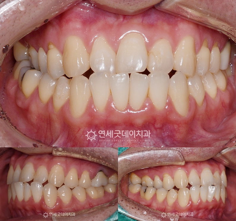 결손치 인비절라인 및 앞니 임플란트 치료 전 모습