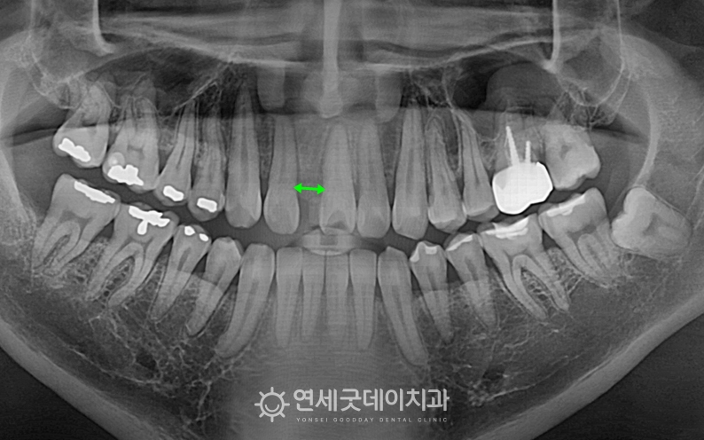 결손치 개선을 위해 인비절라인을 이용해 공간확보 진행 중