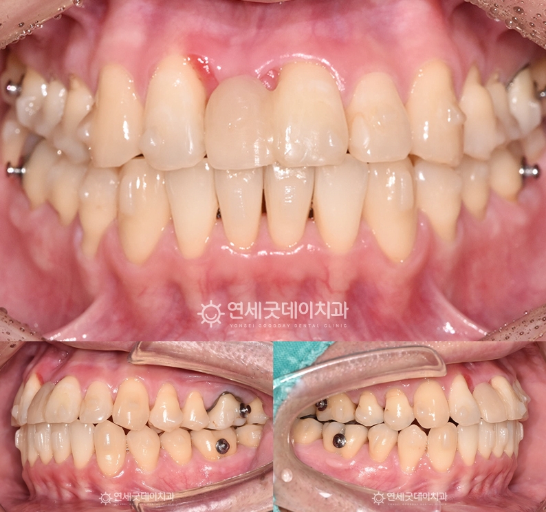 결손치 부위의 공간 확보를 위해 인비절라인 교정 진행 중