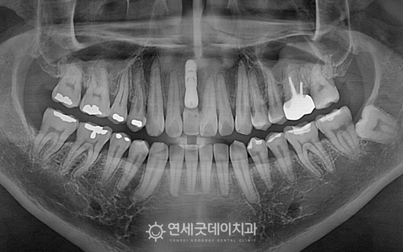 인비절라인 교정 진행 중, 상악 공간 확보 후 앞니 임플란트 식립
