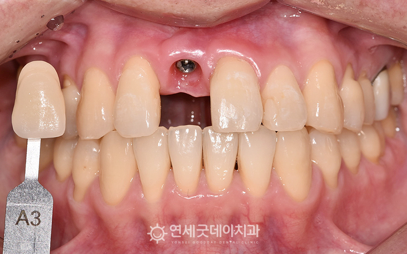결손치 부위에 앞니 임플란트 식립