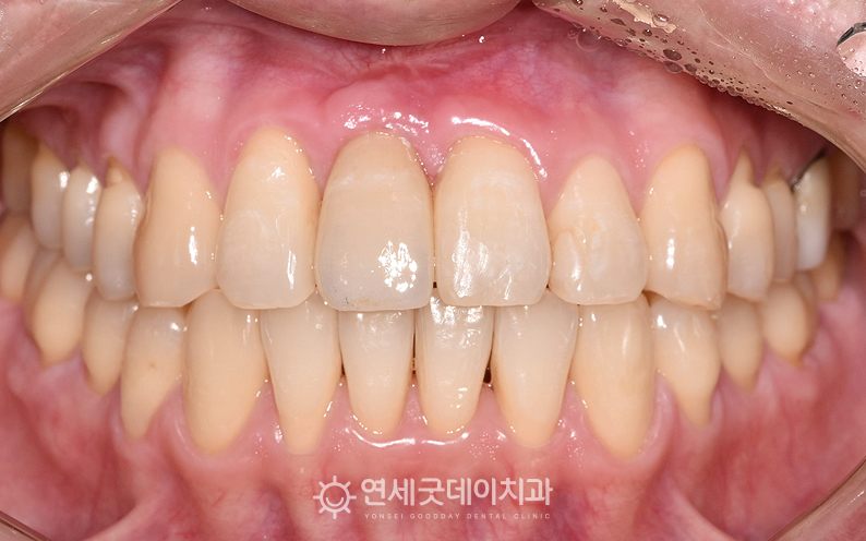 인비절라인 및 앞니 임플란트를 통한 결손치 개선