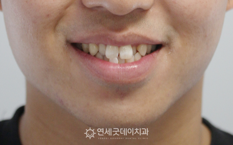 덧니치아교정 전 치아 배열이 삐뚤빼뚤한 모습(안모)