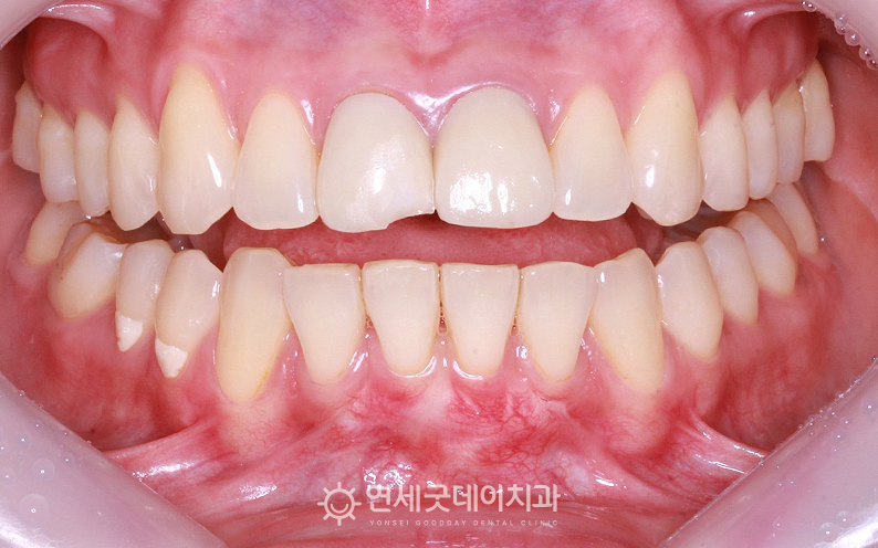 앞니 크라운 교체와 순소대절제술 희망하여 방문하심