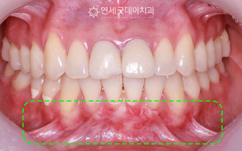 순소대절제술 전 순소대가 하악 잇몸을 당기는 모습