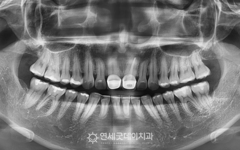 앞니 크라운 교체 및 순소대절제술 치료전 엑스레이