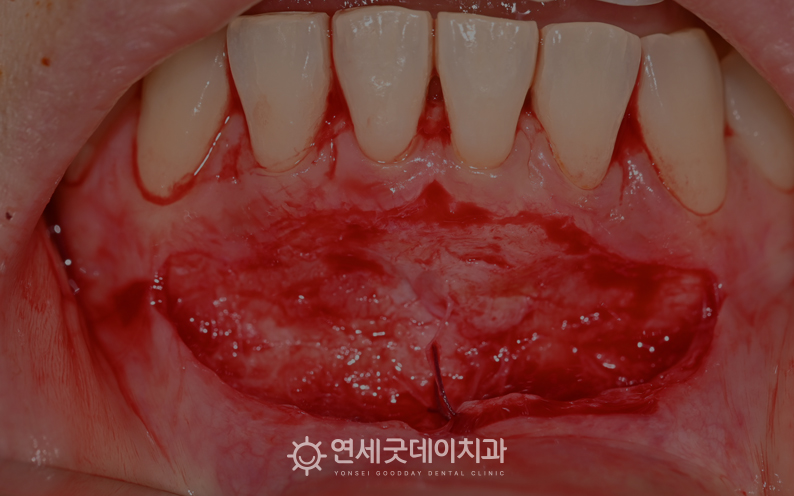 순소대절제술 진행 과정(1)