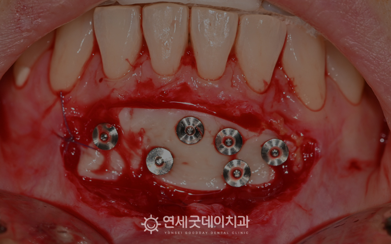 순소대절제술 진행 과정(2)