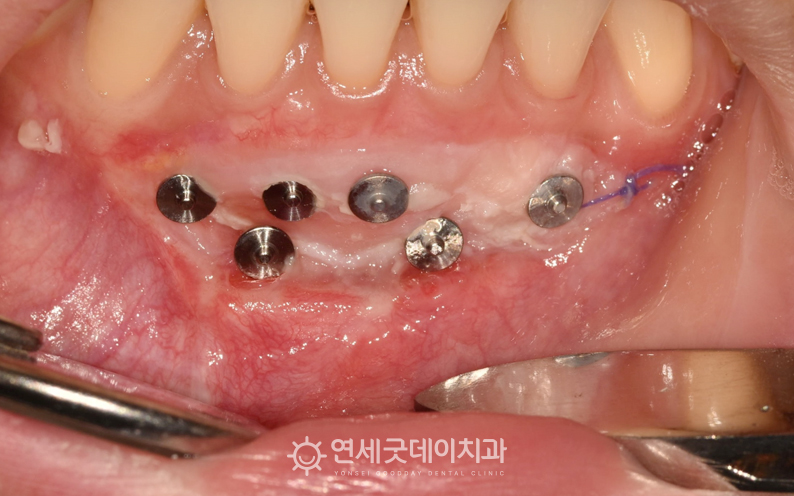 순소대절제술 진행 후 2주 경과