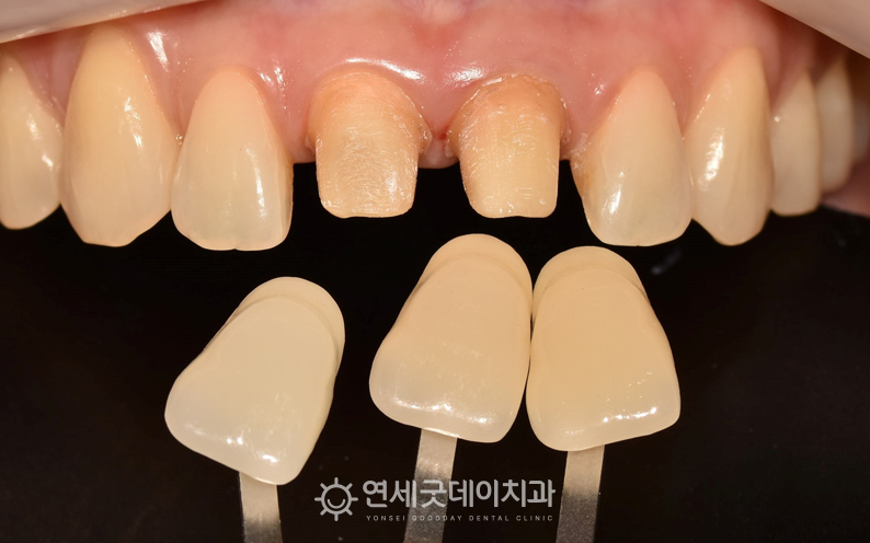 앞니 크라운 교체를 위한 쉐이드 대조 진행(1)