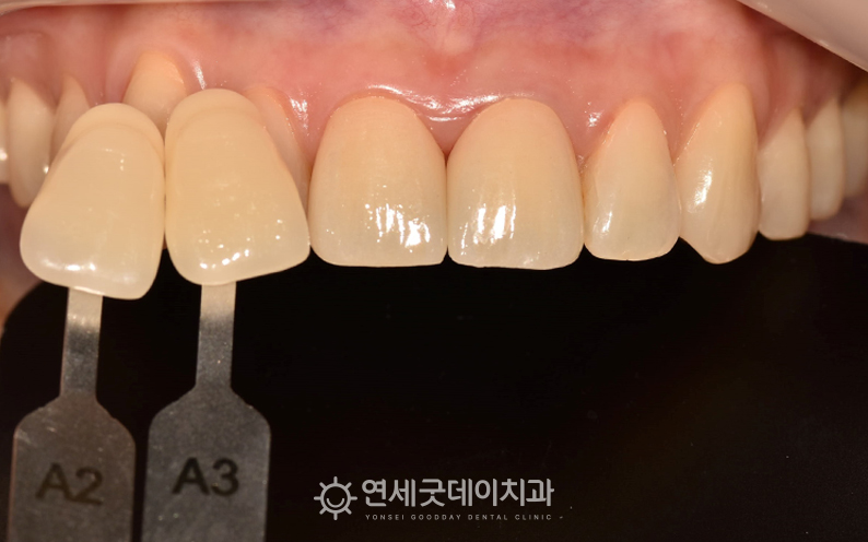 앞니 크라운 교체를 위한 쉐이드 대조 진행(2)