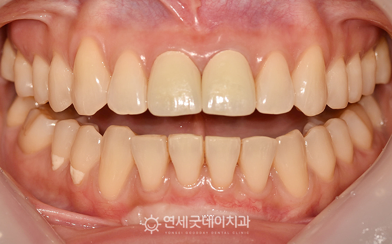 앞니 크라운 교체 및 순소대절제술 마무리