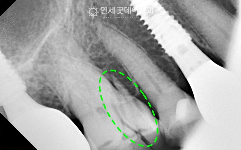 치아 부러짐으로 인해 내원하심 어금니 임플란트 치료 전