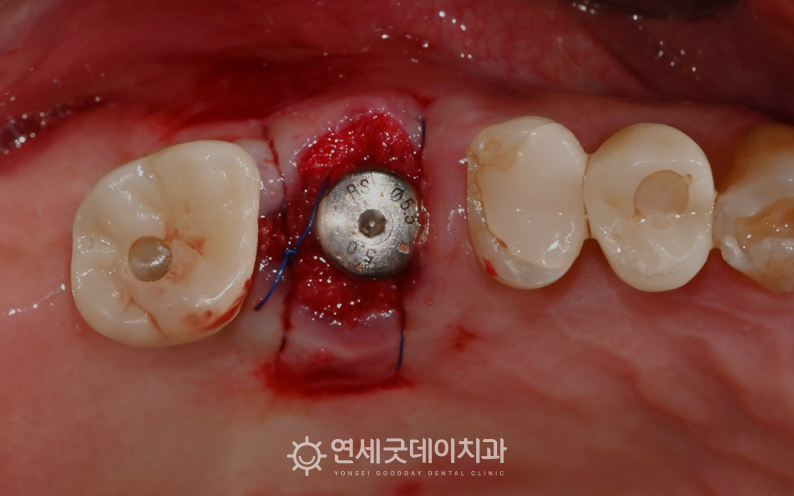 치아 부러짐으로 인해 발치 후 어금니 임플란트 식립