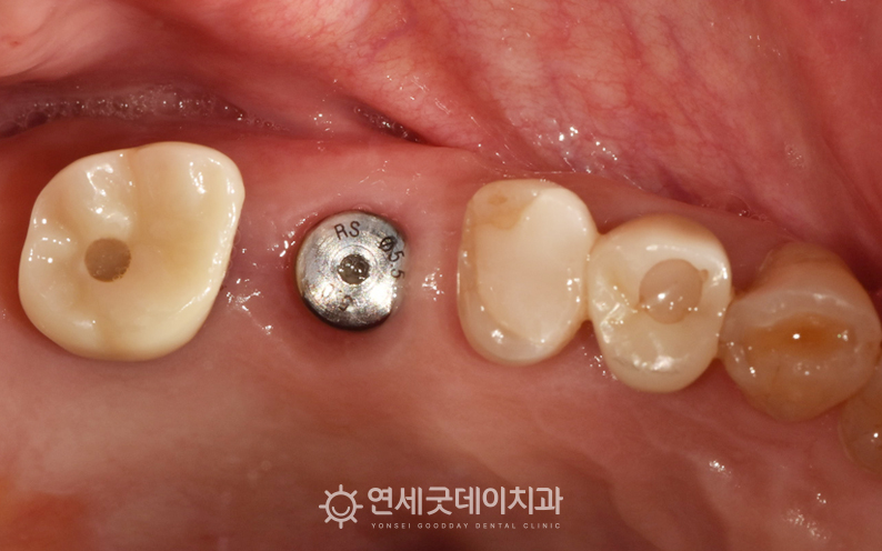 어금니 임플란트 힐링