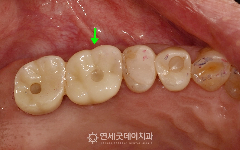 어금니 임플란트 보철물 장착